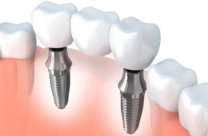 базални зъбни импланти